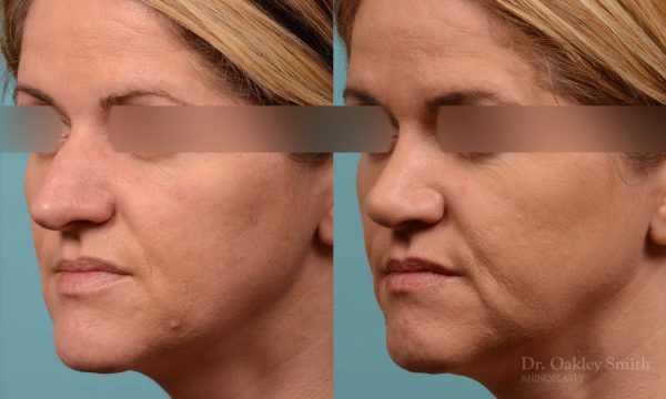 rhinoplasty nose reduction female