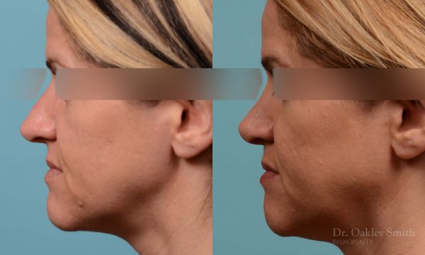 rhinoplasty nose reduction female
