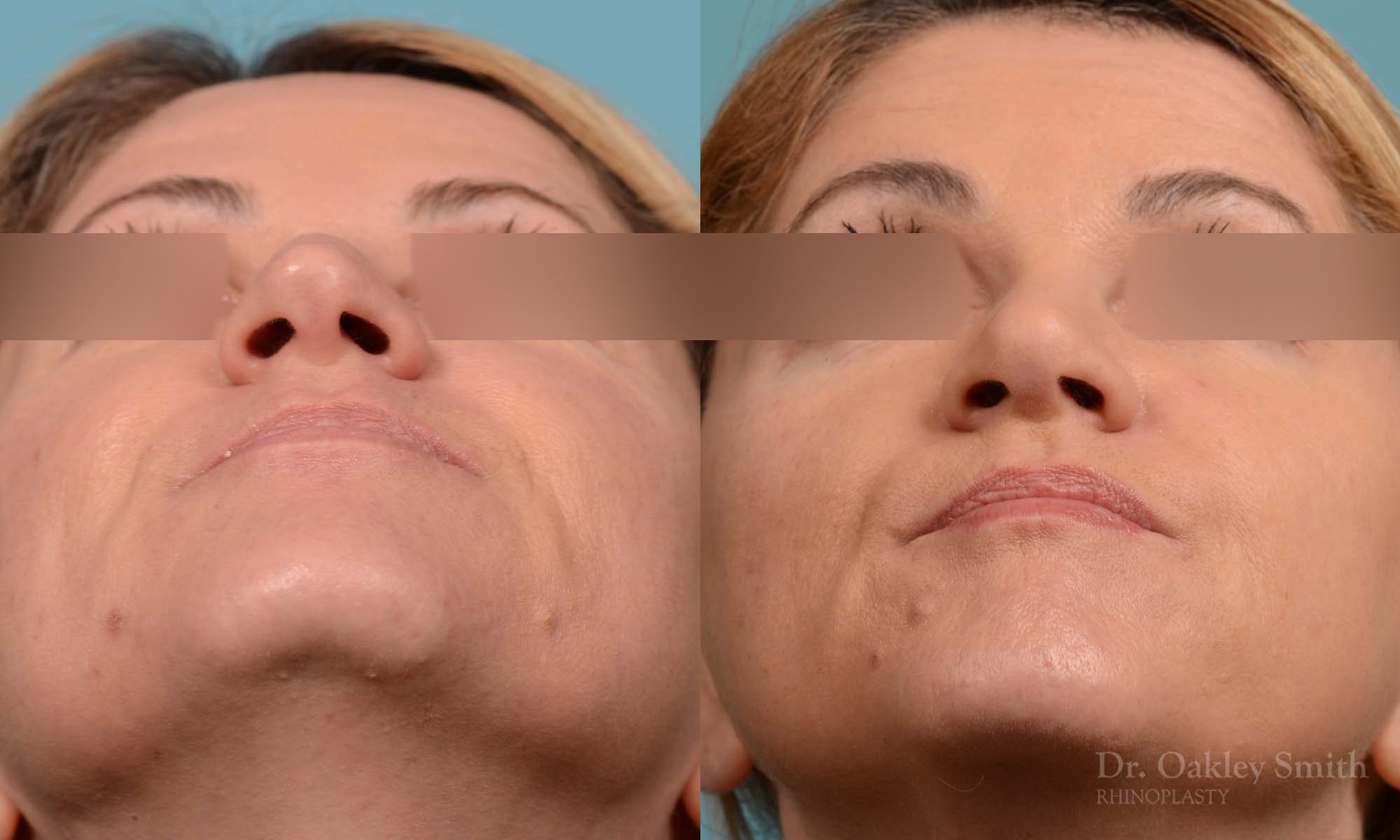 rhinoplasty nose reduction female