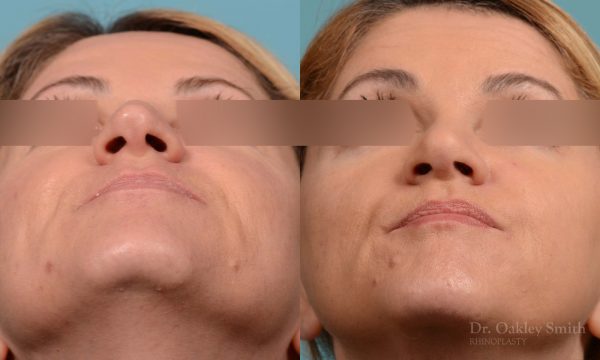 rhinoplasty nose reduction female