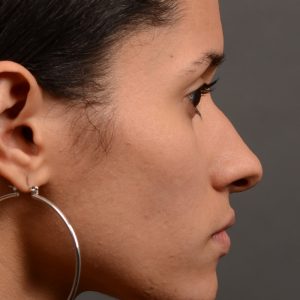 female rhinoplasty hump reduction