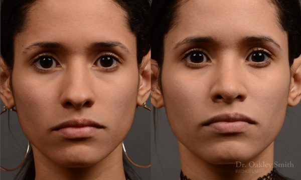 female rhinoplasty hump reduction