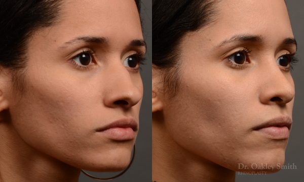 female rhinoplasty hump reduction