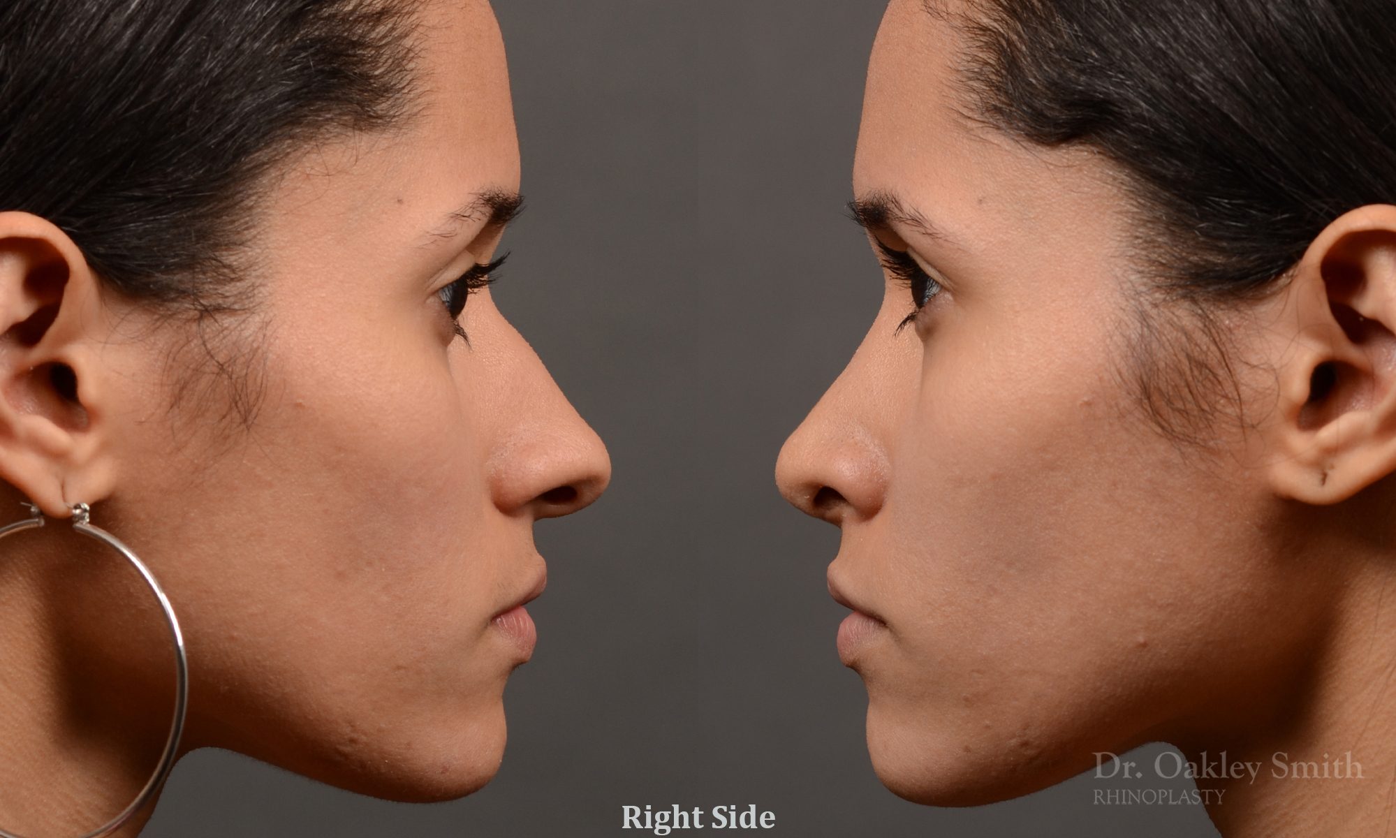 female rhinoplasty hump reduction