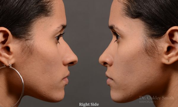 female rhinoplasty hump reduction
