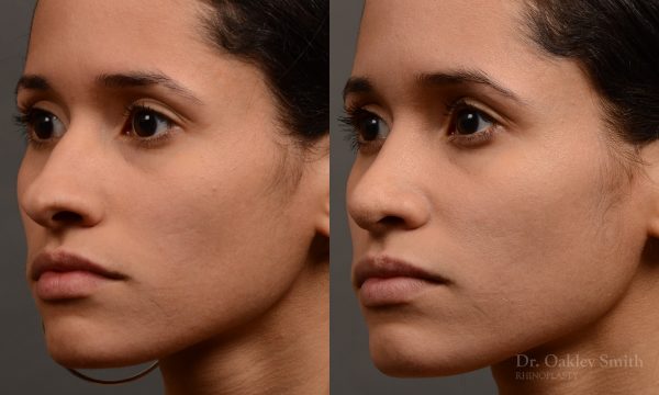 female rhinoplasty hump reduction