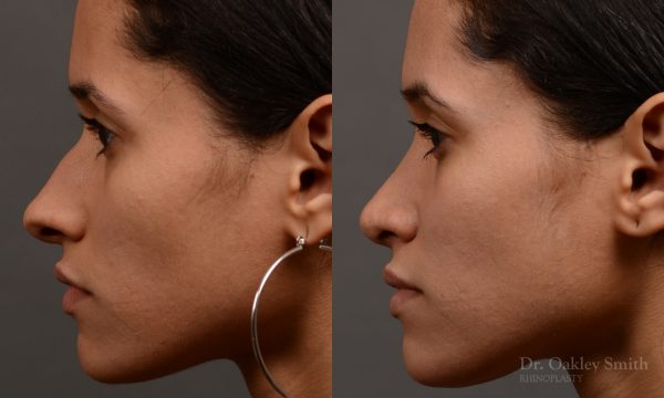 female rhinoplasty hump reduction