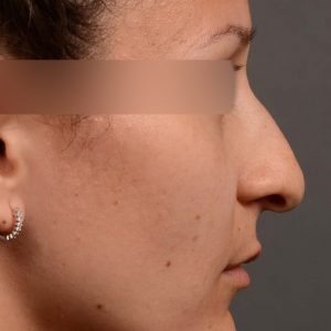 rhinoplasty Nothing demonstrates the skillful craftsmanship that Dr. Oakley Smith accomplishes during his surgeries than a collection of before and after case studies. As one of a hand full of surgeons in North America who limits his practice to only Rhinoplasty surgery, it is obvious that he has mastered his art. There is no question why he is one of the busiest cosmetic nose job surgeons in the country.