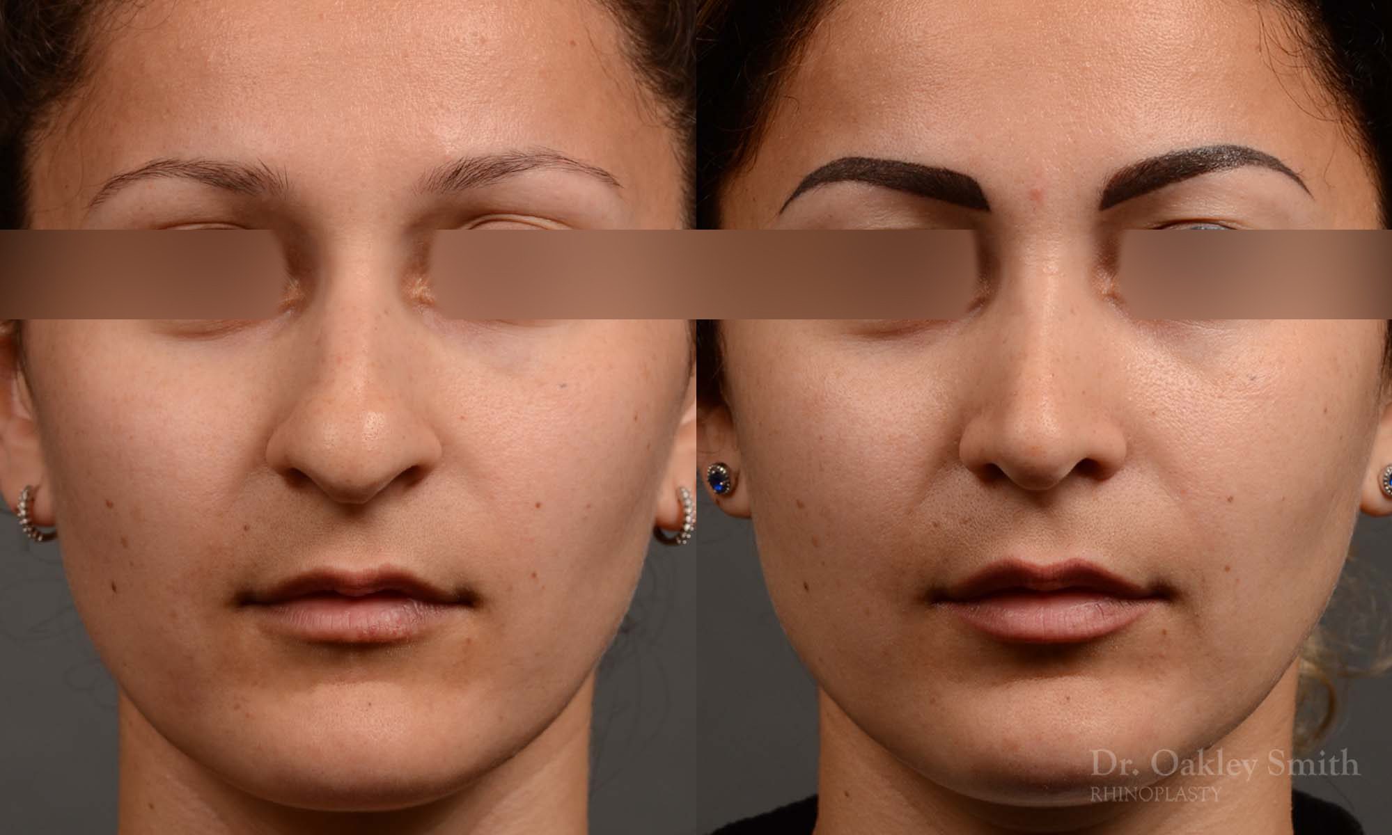rhinoplasty Nothing demonstrates the skillful craftsmanship that Dr. Oakley Smith accomplishes during his surgeries than a collection of before and after case studies. As one of a hand full of surgeons in North America who limits his practice to only Rhinoplasty surgery, it is obvious that he has mastered his art. There is no question why he is one of the busiest cosmetic nose job surgeons in the country.