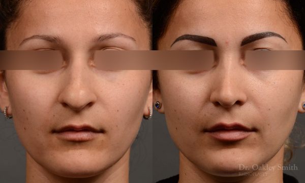 rhinoplasty Nothing demonstrates the skillful craftsmanship that Dr. Oakley Smith accomplishes during his surgeries than a collection of before and after case studies. As one of a hand full of surgeons in North America who limits his practice to only Rhinoplasty surgery, it is obvious that he has mastered his art. There is no question why he is one of the busiest cosmetic nose job surgeons in the country.