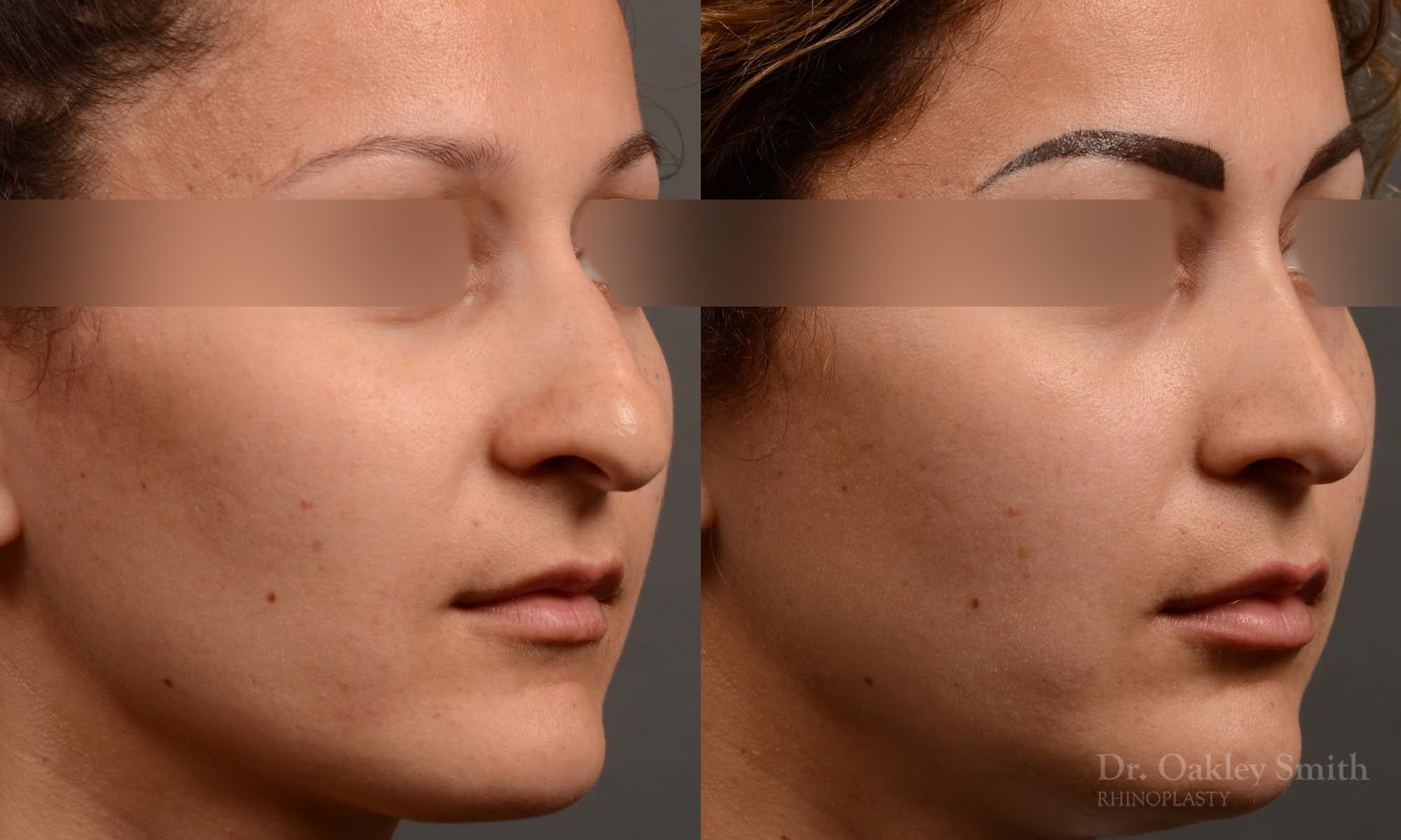 rhinoplasty Nothing demonstrates the skillful craftsmanship that Dr. Oakley Smith accomplishes during his surgeries than a collection of before and after case studies. As one of a hand full of surgeons in North America who limits his practice to only Rhinoplasty surgery, it is obvious that he has mastered his art. There is no question why he is one of the busiest cosmetic nose job surgeons in the country.