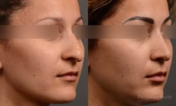rhinoplasty Nothing demonstrates the skillful craftsmanship that Dr. Oakley Smith accomplishes during his surgeries than a collection of before and after case studies. As one of a hand full of surgeons in North America who limits his practice to only Rhinoplasty surgery, it is obvious that he has mastered his art. There is no question why he is one of the busiest cosmetic nose job surgeons in the country.