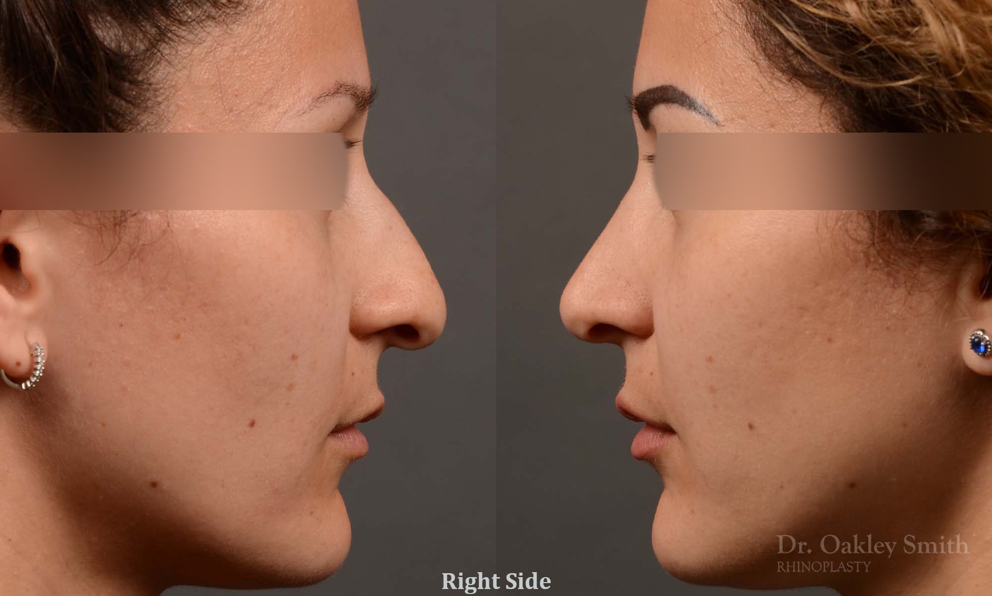 rhinoplasty Nothing demonstrates the skillful craftsmanship that Dr. Oakley Smith accomplishes during his surgeries than a collection of before and after case studies. As one of a hand full of surgeons in North America who limits his practice to only Rhinoplasty surgery, it is obvious that he has mastered his art. There is no question why he is one of the busiest cosmetic nose job surgeons in the country.