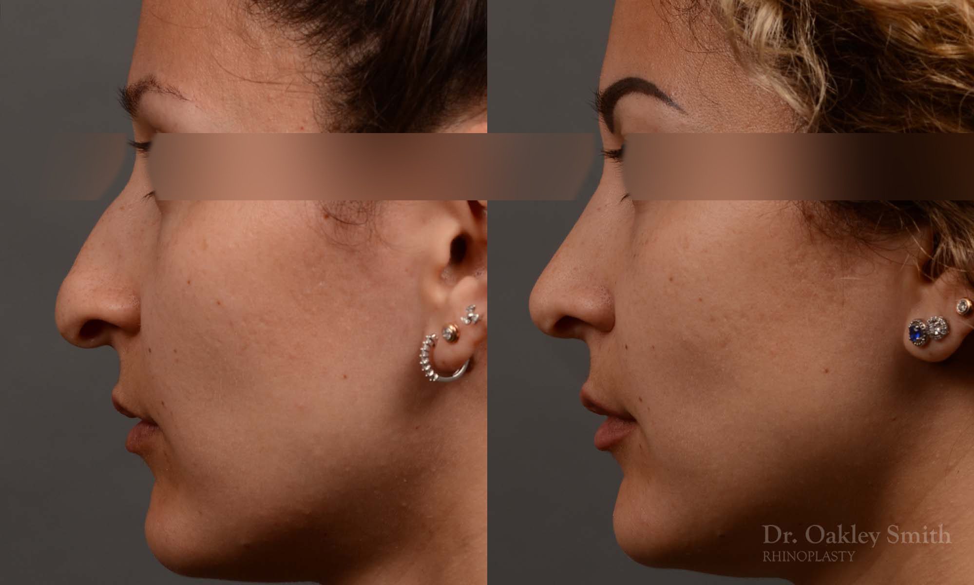 rhinoplasty Nothing demonstrates the skillful craftsmanship that Dr. Oakley Smith accomplishes during his surgeries than a collection of before and after case studies. As one of a hand full of surgeons in North America who limits his practice to only Rhinoplasty surgery, it is obvious that he has mastered his art. There is no question why he is one of the busiest cosmetic nose job surgeons in the country.
