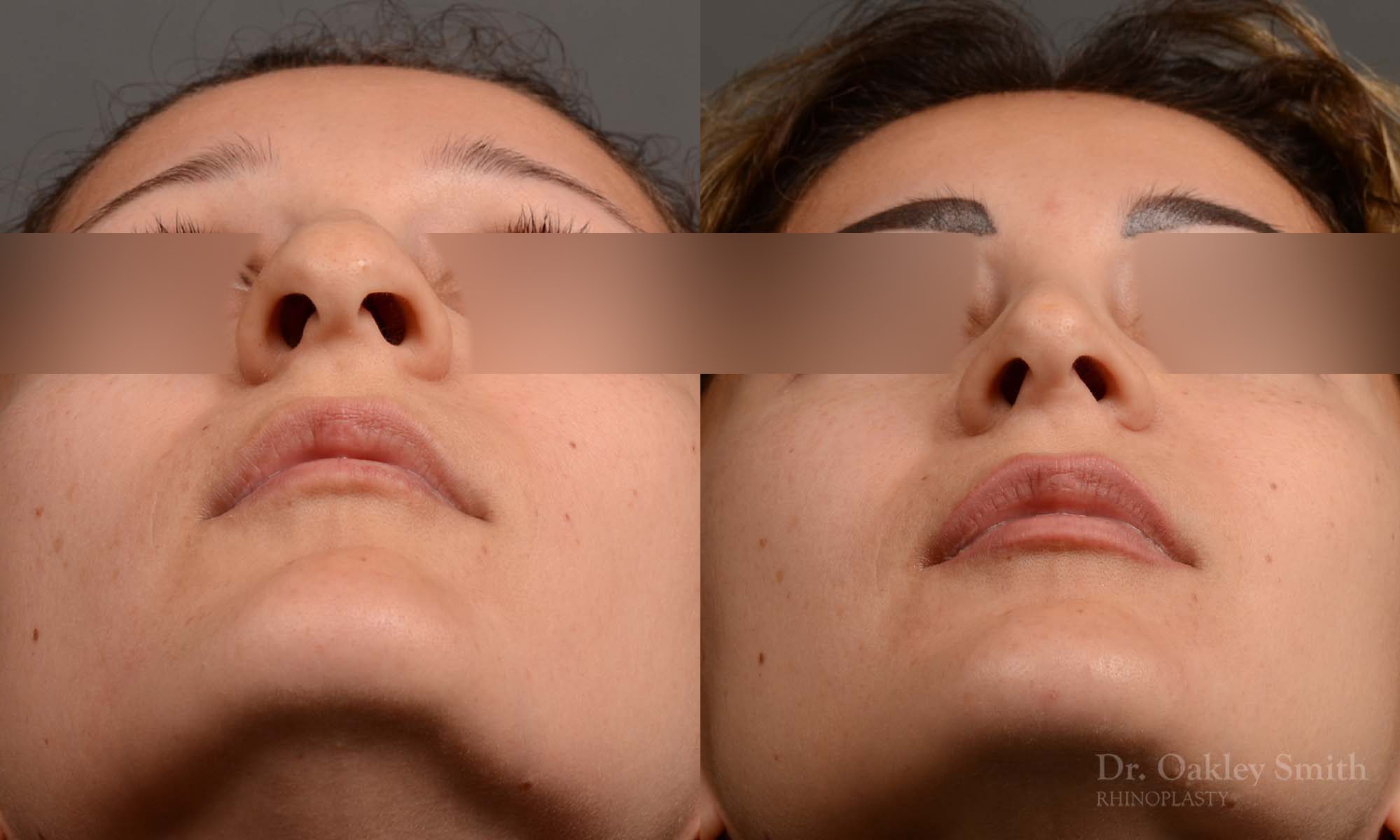 rhinoplasty Nothing demonstrates the skillful craftsmanship that Dr. Oakley Smith accomplishes during his surgeries than a collection of before and after case studies. As one of a hand full of surgeons in North America who limits his practice to only Rhinoplasty surgery, it is obvious that he has mastered his art. There is no question why he is one of the busiest cosmetic nose job surgeons in the country.