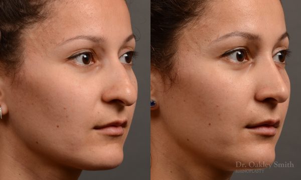 This young woman wanted her hump removed and felt her nose was too large for her face and her nasal tip to heavy.