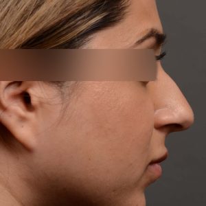 Our young female patient felt her nose was too projected out from her face. This is another way of saying the nose is too large for the face it sits on.