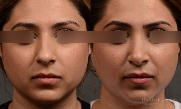 female nose reduction rhinoplasty that reduced the overall size of this womans nose