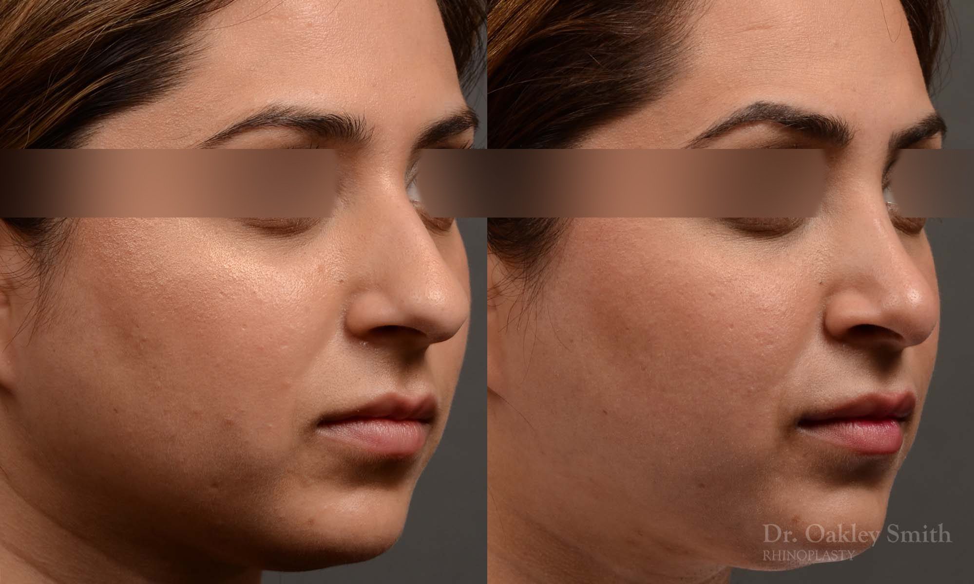 female nose reduction rhinoplasty that reduced the overall size of this womans nose