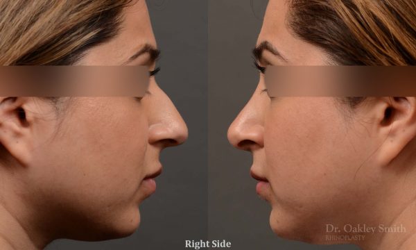 female nose reduction rhinoplasty that reduced the overall size of this womans nose