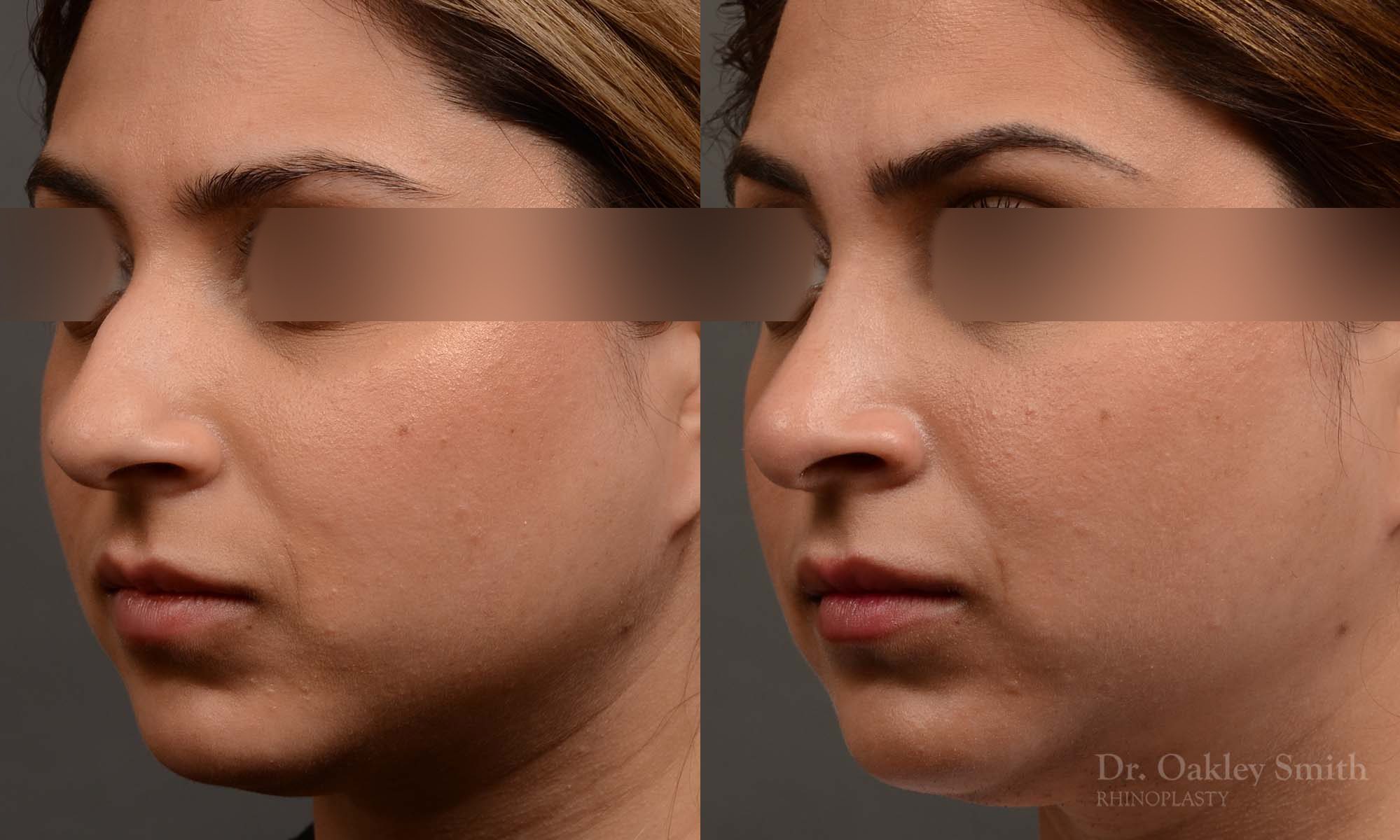 female nose reduction rhinoplasty that reduced the overall size of this womans nose