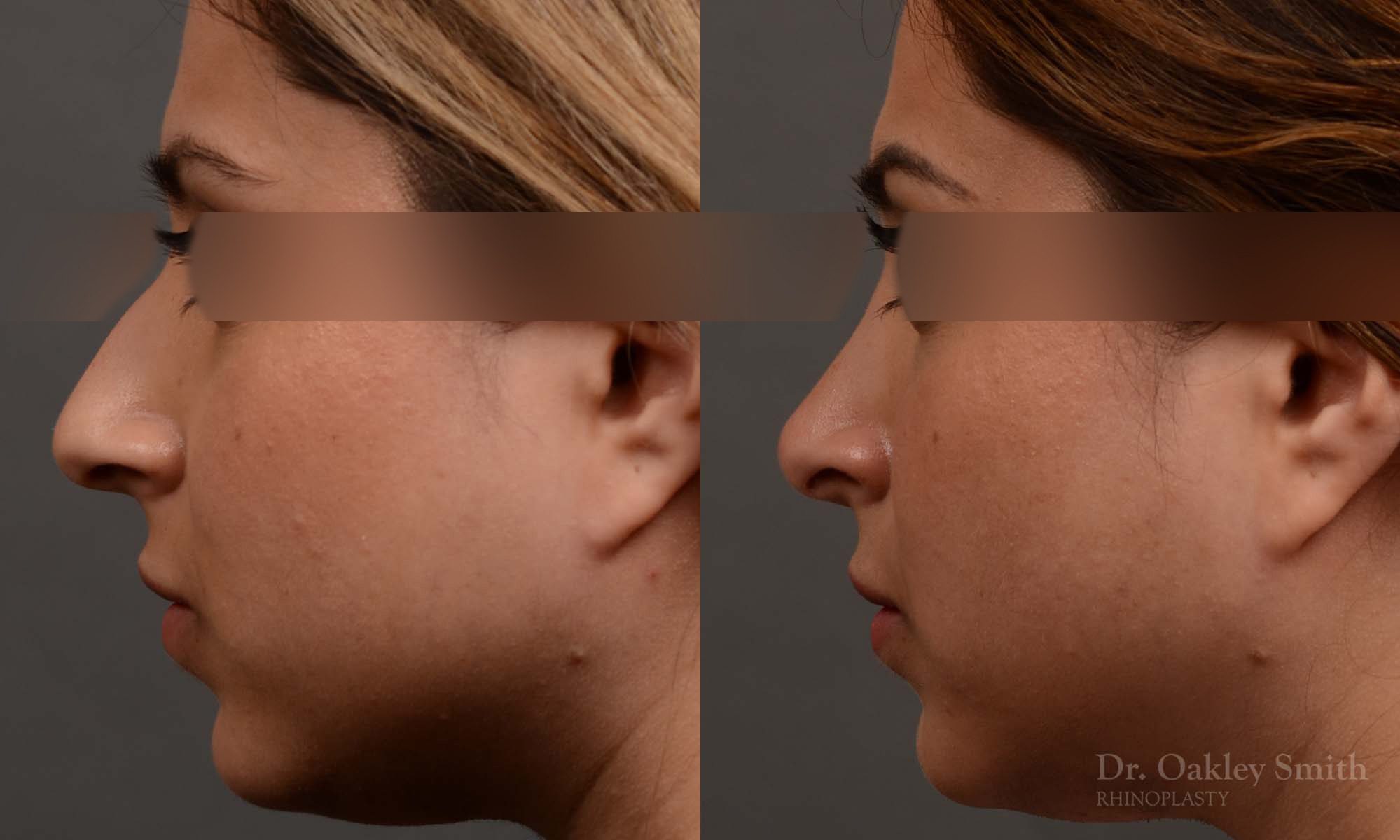 female nose reduction rhinoplasty that reduced the overall size of this womans nose