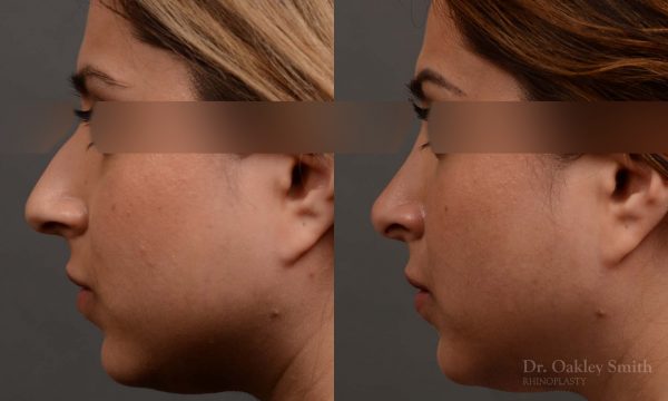 female nose reduction rhinoplasty that reduced the overall size of this womans nose