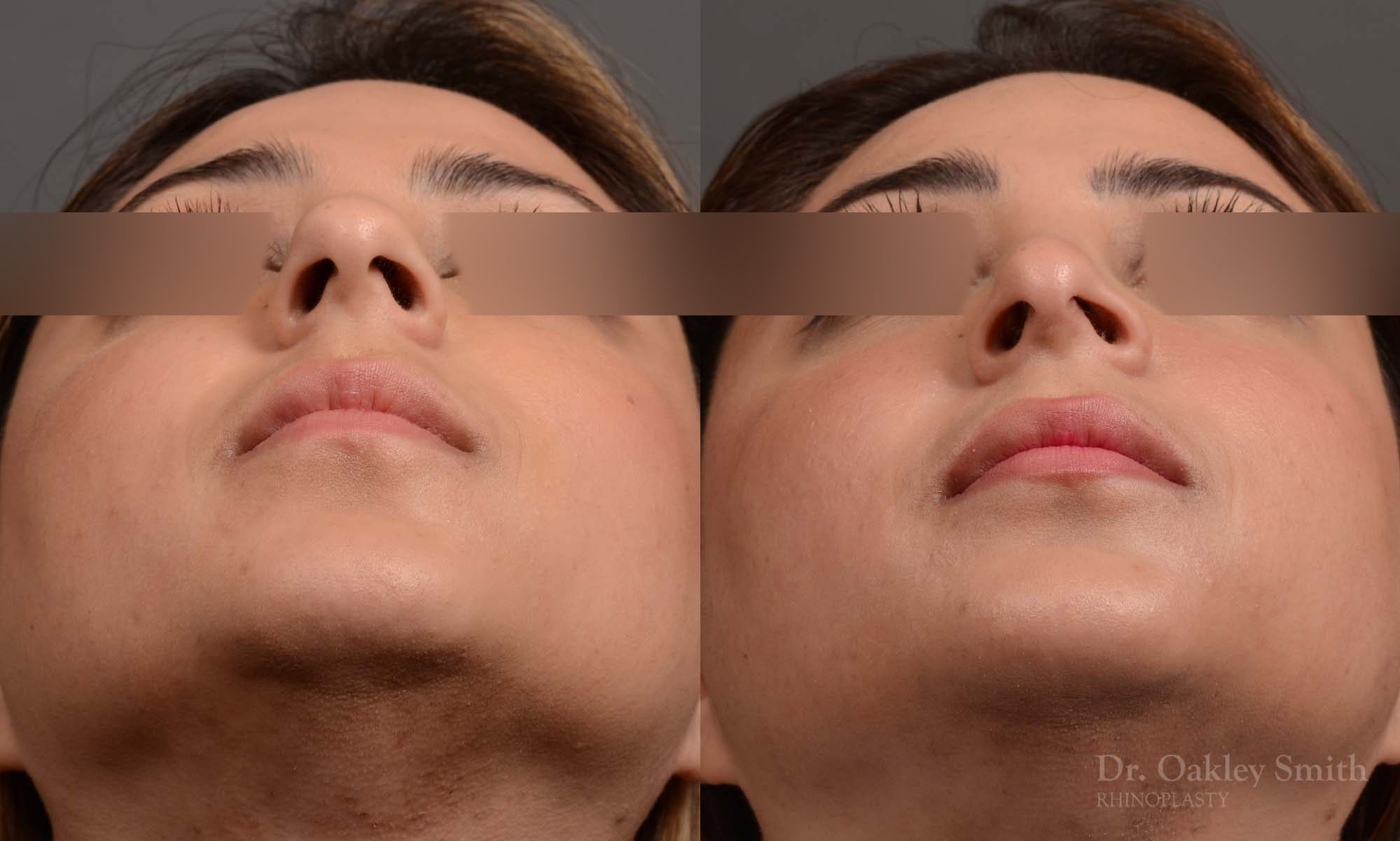 female nose reduction rhinoplasty that reduced the overall size of this womans nose