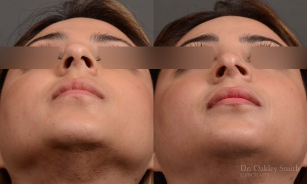 female nose reduction rhinoplasty that reduced the overall size of this womans nose