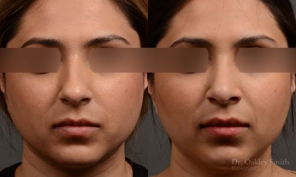 Our young female patient felt her nose was too projected out from her face. This is another way of saying the nose is too large for the face it sits on.