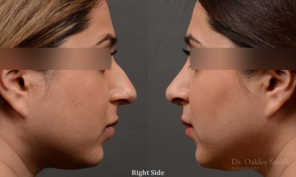 Our young female patient felt her nose was too projected out from her face. This is another way of saying the nose is too large for the face it sits on.