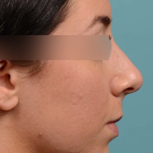 Rhinoplasty to reduce the overall size of her nose