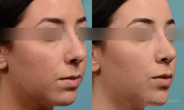 Rhinoplasty to reduce the overall size of her nose