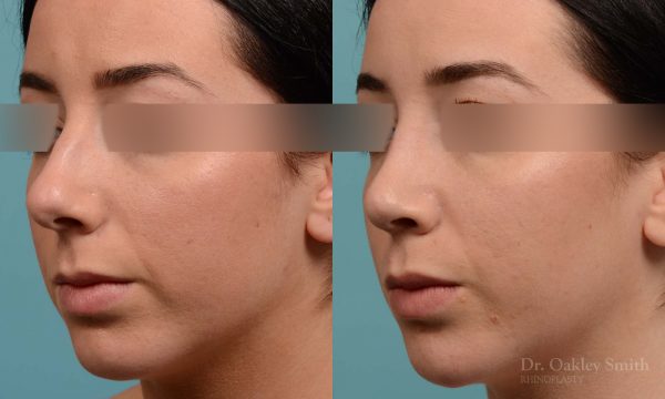 Rhinoplasty to reduce the overall size of her nose
