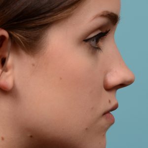Rhinoplasty to smoothen the tip of nose