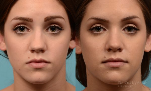 Rhinoplasty to smoothen the tip of nose