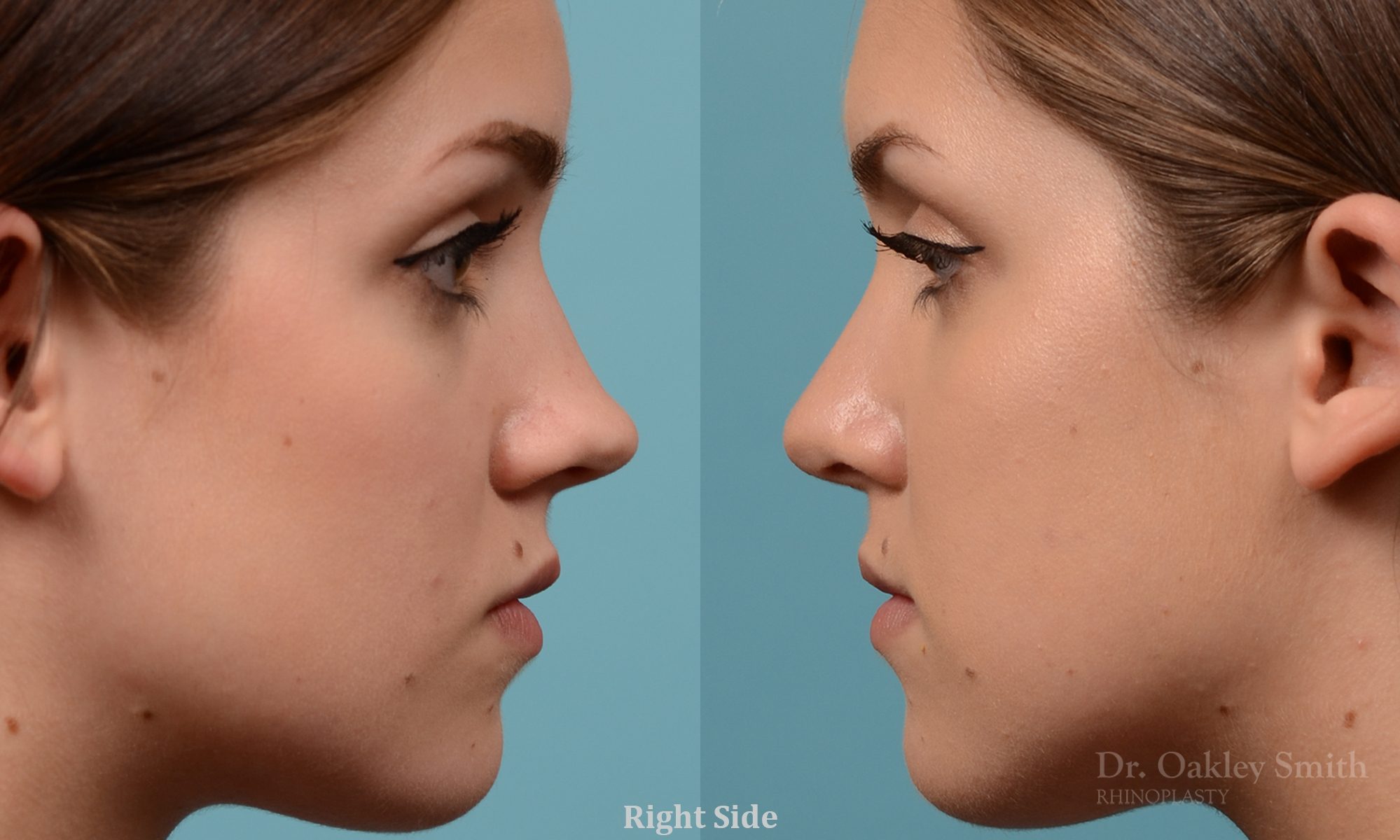 Rhinoplasty to smoothen the tip of nose