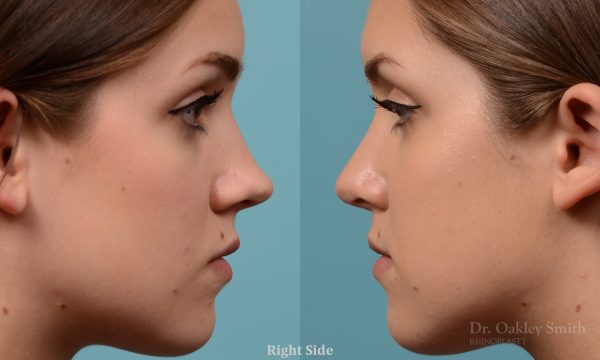 Rhinoplasty to smoothen the tip of nose