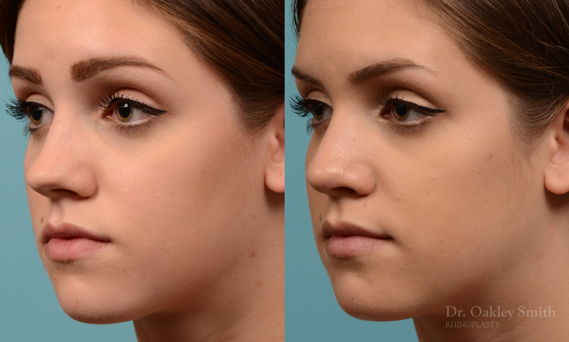 Rhinoplasty to smoothen the tip of nose