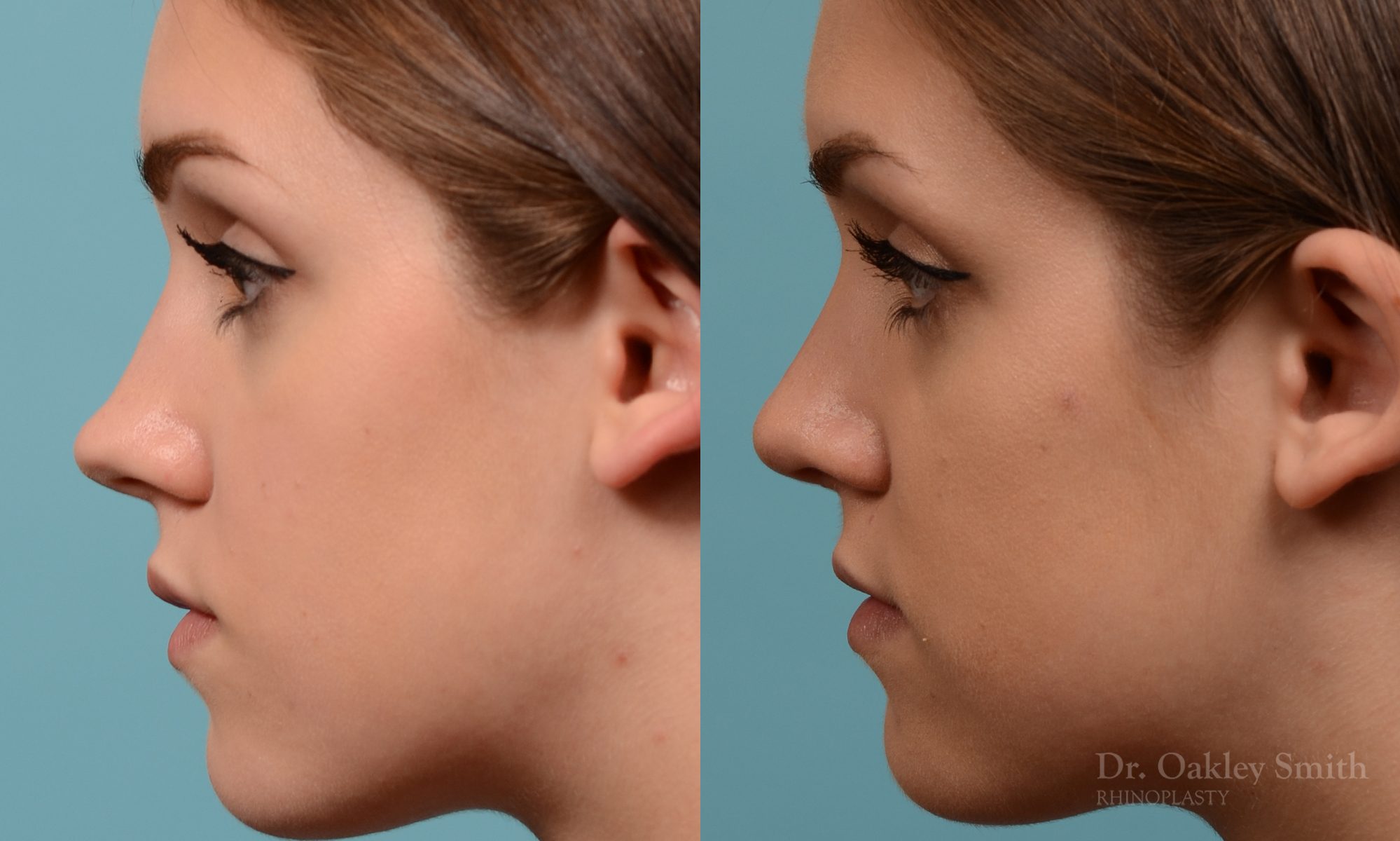 Rhinoplasty to smoothen the tip of nose