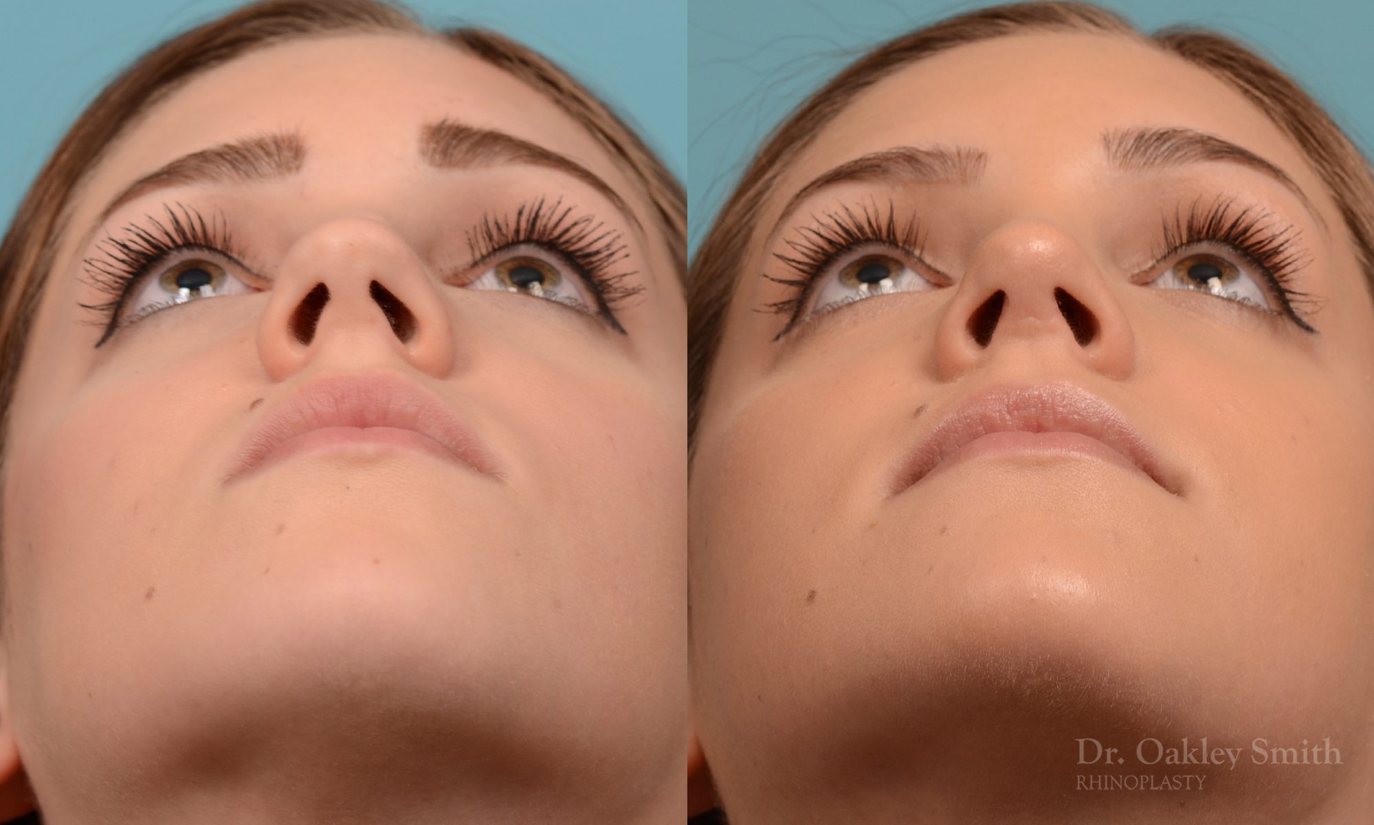 Rhinoplasty to smoothen the tip of nose