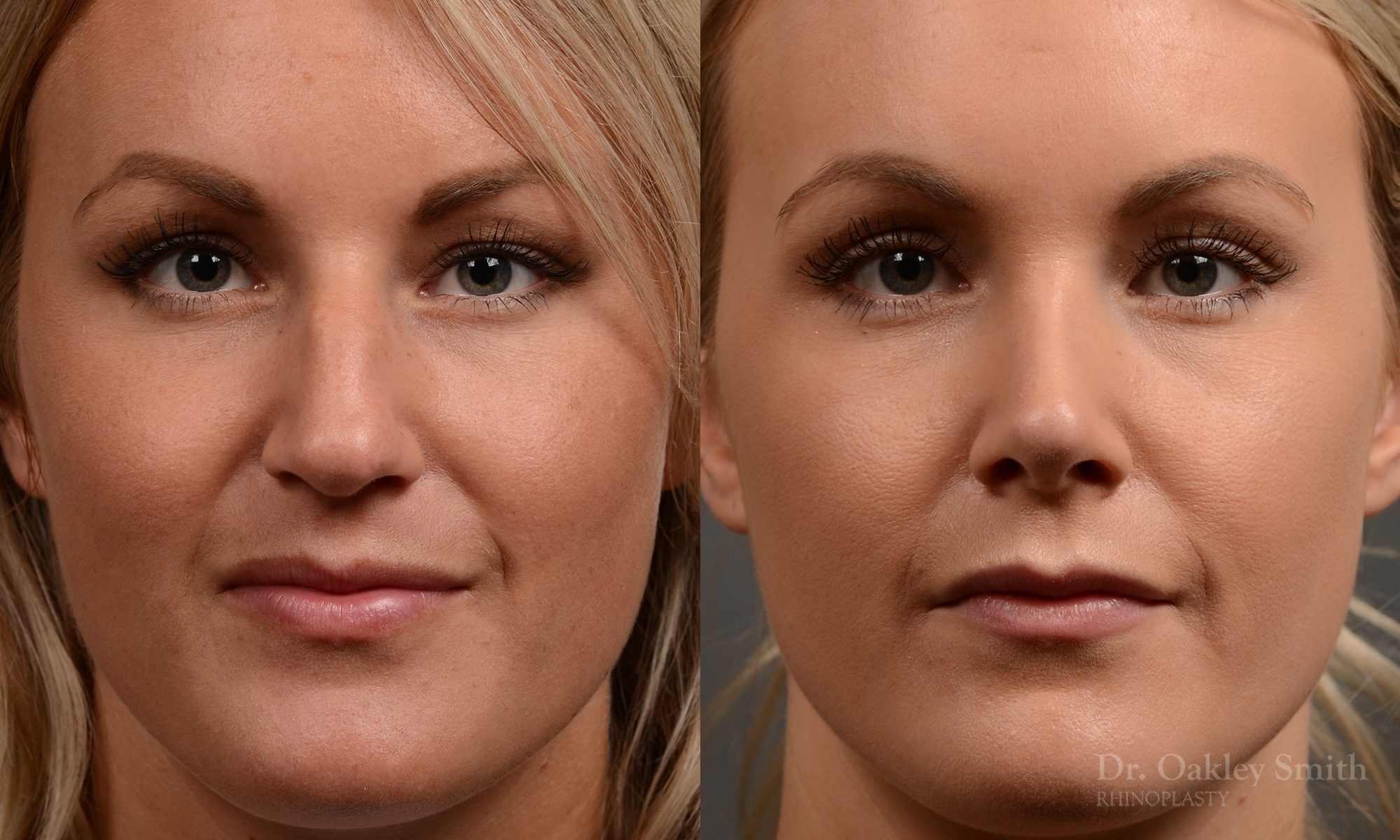 rhinoplasty Nothing demonstrates the skillful craftsmanship that Dr. Oakley Smith accomplishes during his surgeries than a collection of before and after case studies. As one of a hand full of surgeons in North America who limits his practice to only Rhinoplasty surgery, it is obvious that he has mastered his art. There is no question why he is one of the busiest cosmetic nose job surgeons in the country.
