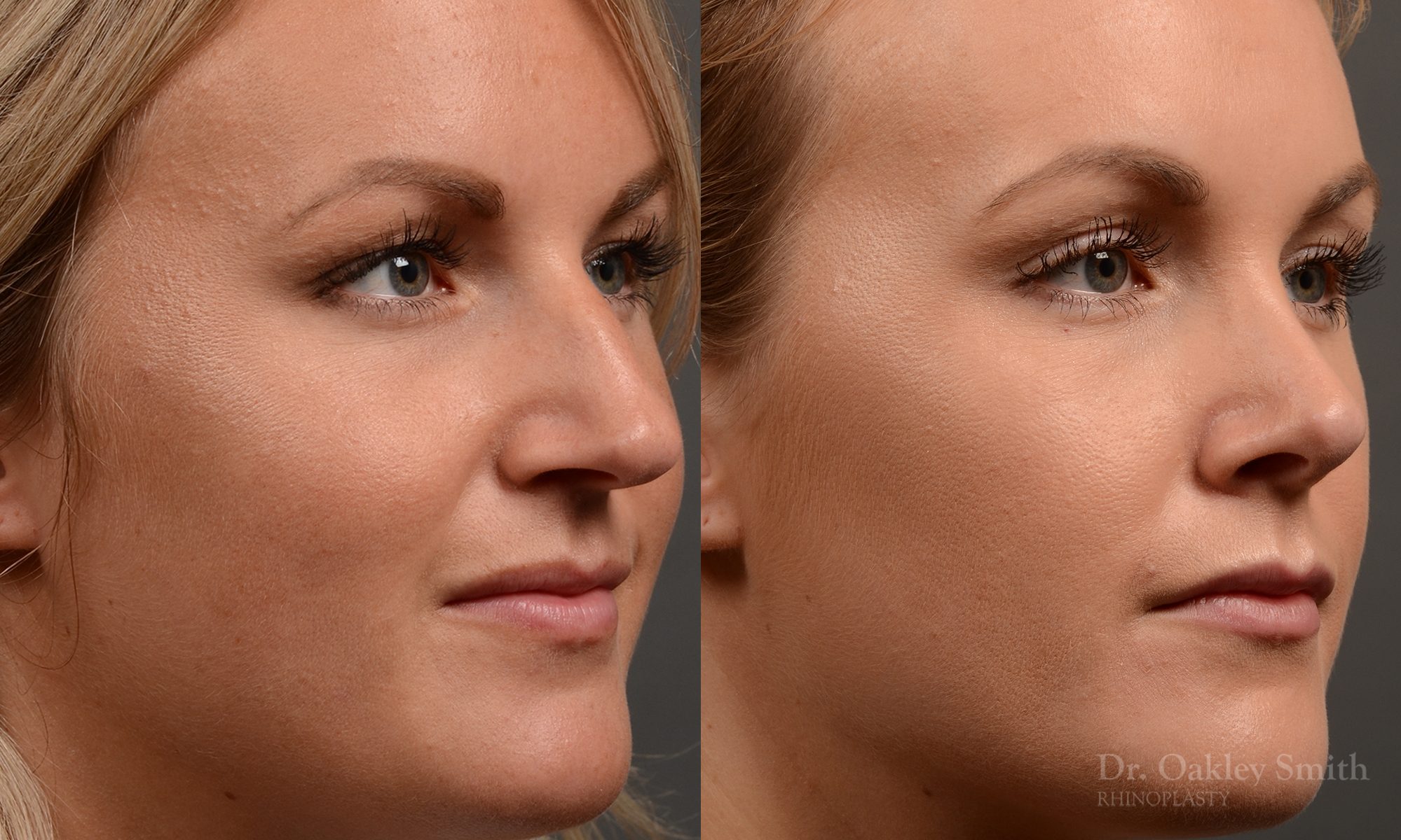 rhinoplasty Nothing demonstrates the skillful craftsmanship that Dr. Oakley Smith accomplishes during his surgeries than a collection of before and after case studies. As one of a hand full of surgeons in North America who limits his practice to only Rhinoplasty surgery, it is obvious that he has mastered his art. There is no question why he is one of the busiest cosmetic nose job surgeons in the country.