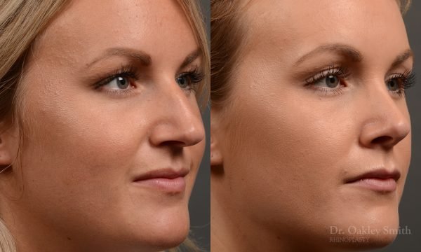 rhinoplasty Nothing demonstrates the skillful craftsmanship that Dr. Oakley Smith accomplishes during his surgeries than a collection of before and after case studies. As one of a hand full of surgeons in North America who limits his practice to only Rhinoplasty surgery, it is obvious that he has mastered his art. There is no question why he is one of the busiest cosmetic nose job surgeons in the country.