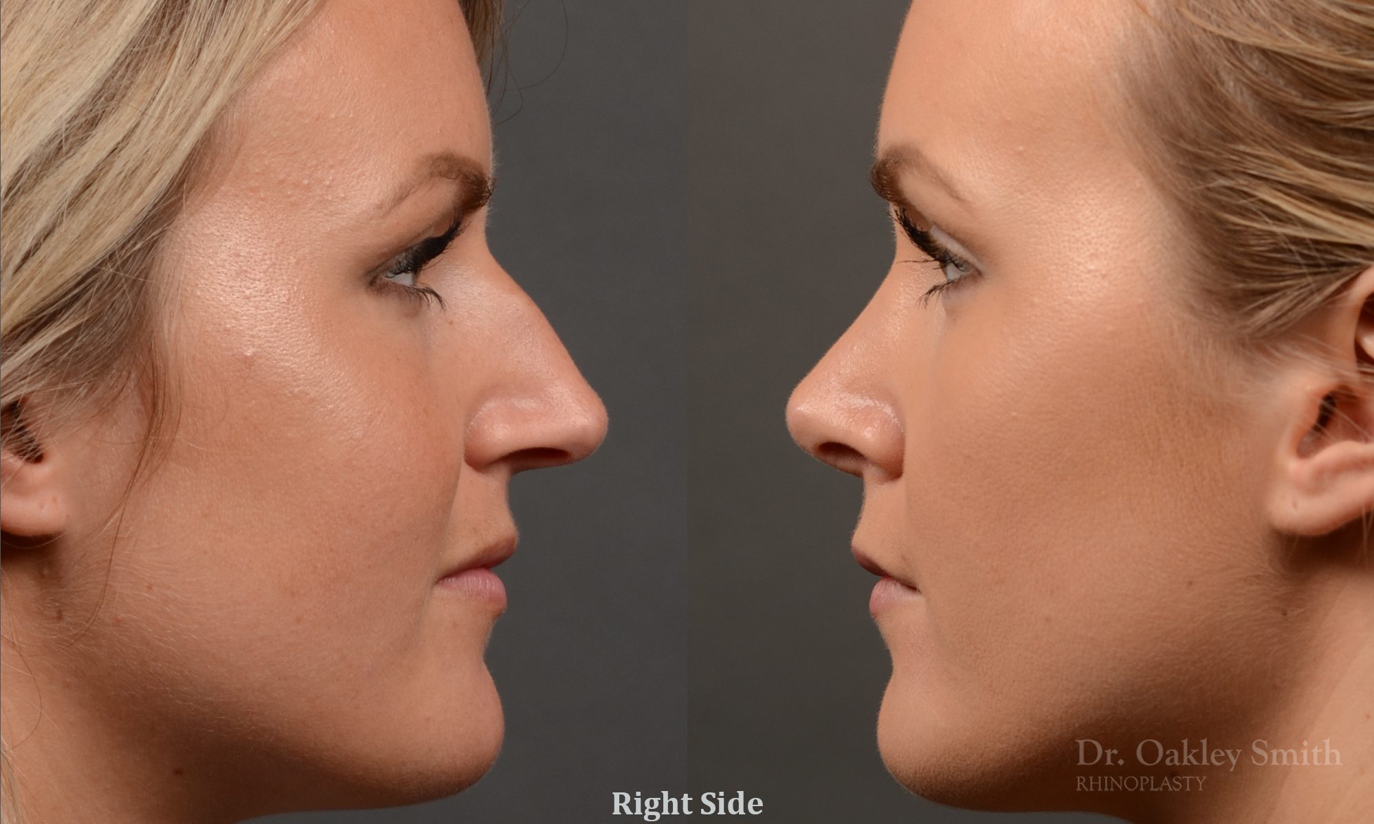 rhinoplasty Nothing demonstrates the skillful craftsmanship that Dr. Oakley Smith accomplishes during his surgeries than a collection of before and after case studies. As one of a hand full of surgeons in North America who limits his practice to only Rhinoplasty surgery, it is obvious that he has mastered his art. There is no question why he is one of the busiest cosmetic nose job surgeons in the country.