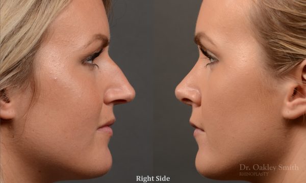 rhinoplasty Nothing demonstrates the skillful craftsmanship that Dr. Oakley Smith accomplishes during his surgeries than a collection of before and after case studies. As one of a hand full of surgeons in North America who limits his practice to only Rhinoplasty surgery, it is obvious that he has mastered his art. There is no question why he is one of the busiest cosmetic nose job surgeons in the country.