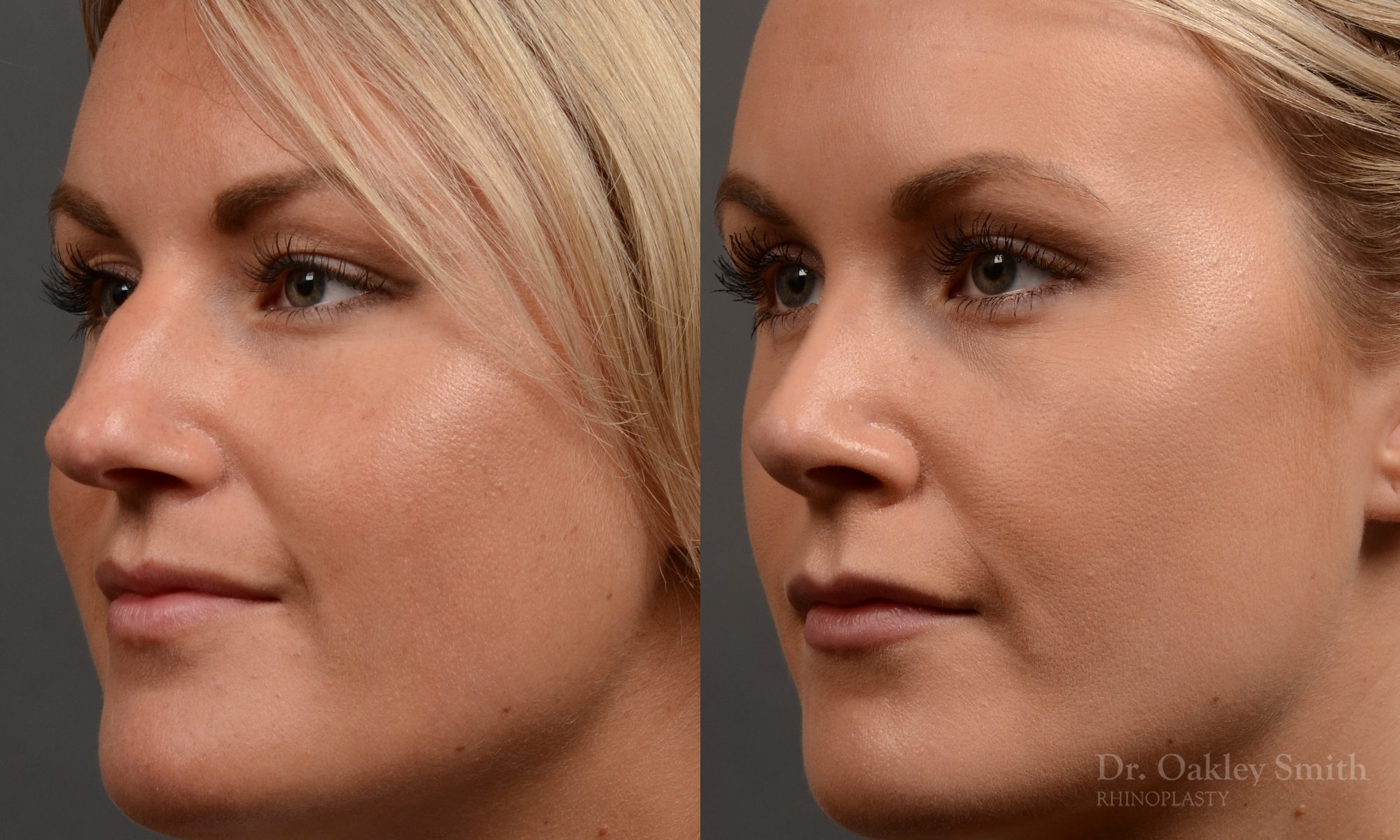 rhinoplasty Nothing demonstrates the skillful craftsmanship that Dr. Oakley Smith accomplishes during his surgeries than a collection of before and after case studies. As one of a hand full of surgeons in North America who limits his practice to only Rhinoplasty surgery, it is obvious that he has mastered his art. There is no question why he is one of the busiest cosmetic nose job surgeons in the country.