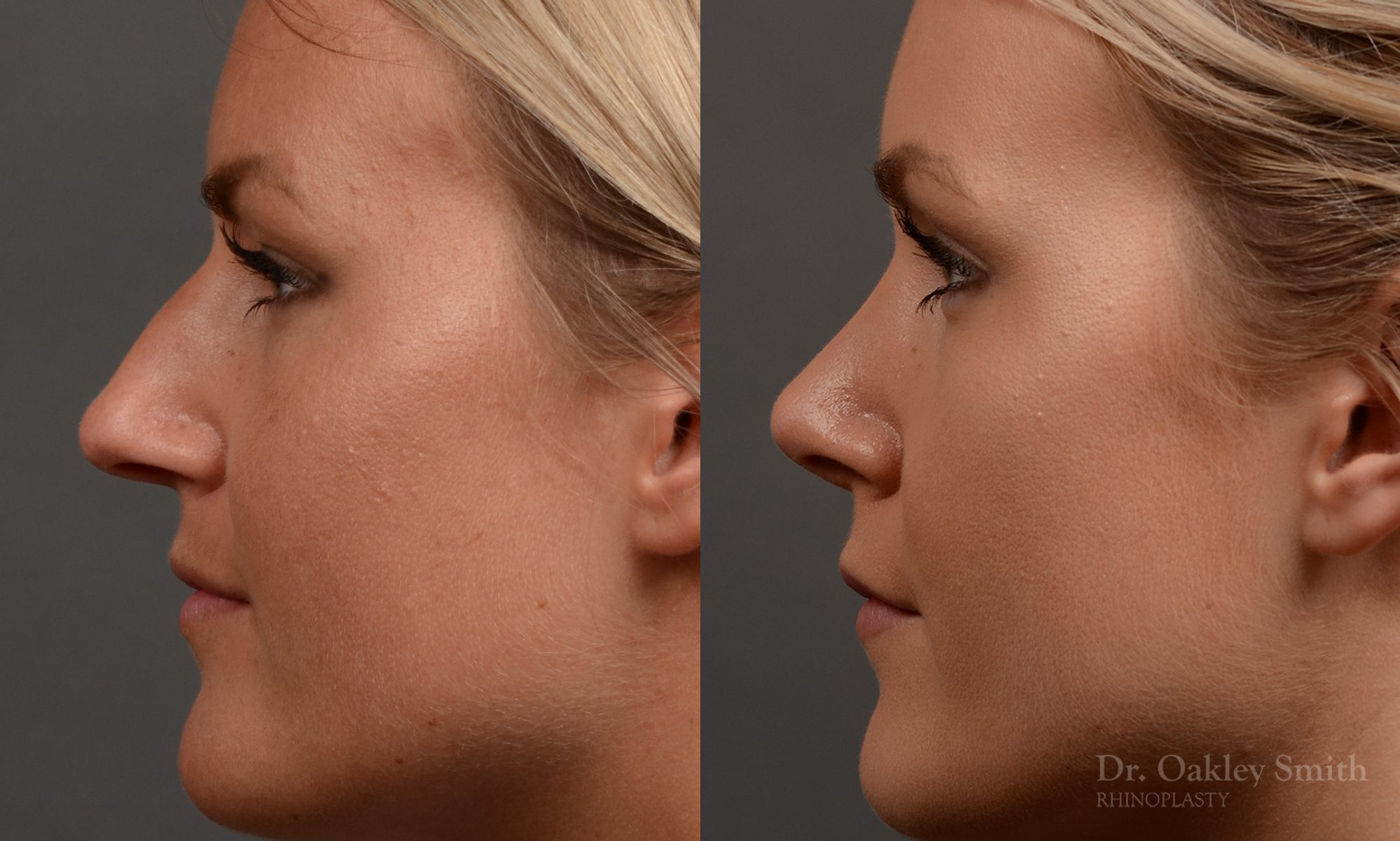 rhinoplasty Nothing demonstrates the skillful craftsmanship that Dr. Oakley Smith accomplishes during his surgeries than a collection of before and after case studies. As one of a hand full of surgeons in North America who limits his practice to only Rhinoplasty surgery, it is obvious that he has mastered his art. There is no question why he is one of the busiest cosmetic nose job surgeons in the country.