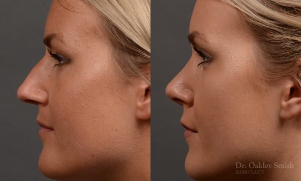rhinoplasty Nothing demonstrates the skillful craftsmanship that Dr. Oakley Smith accomplishes during his surgeries than a collection of before and after case studies. As one of a hand full of surgeons in North America who limits his practice to only Rhinoplasty surgery, it is obvious that he has mastered his art. There is no question why he is one of the busiest cosmetic nose job surgeons in the country.