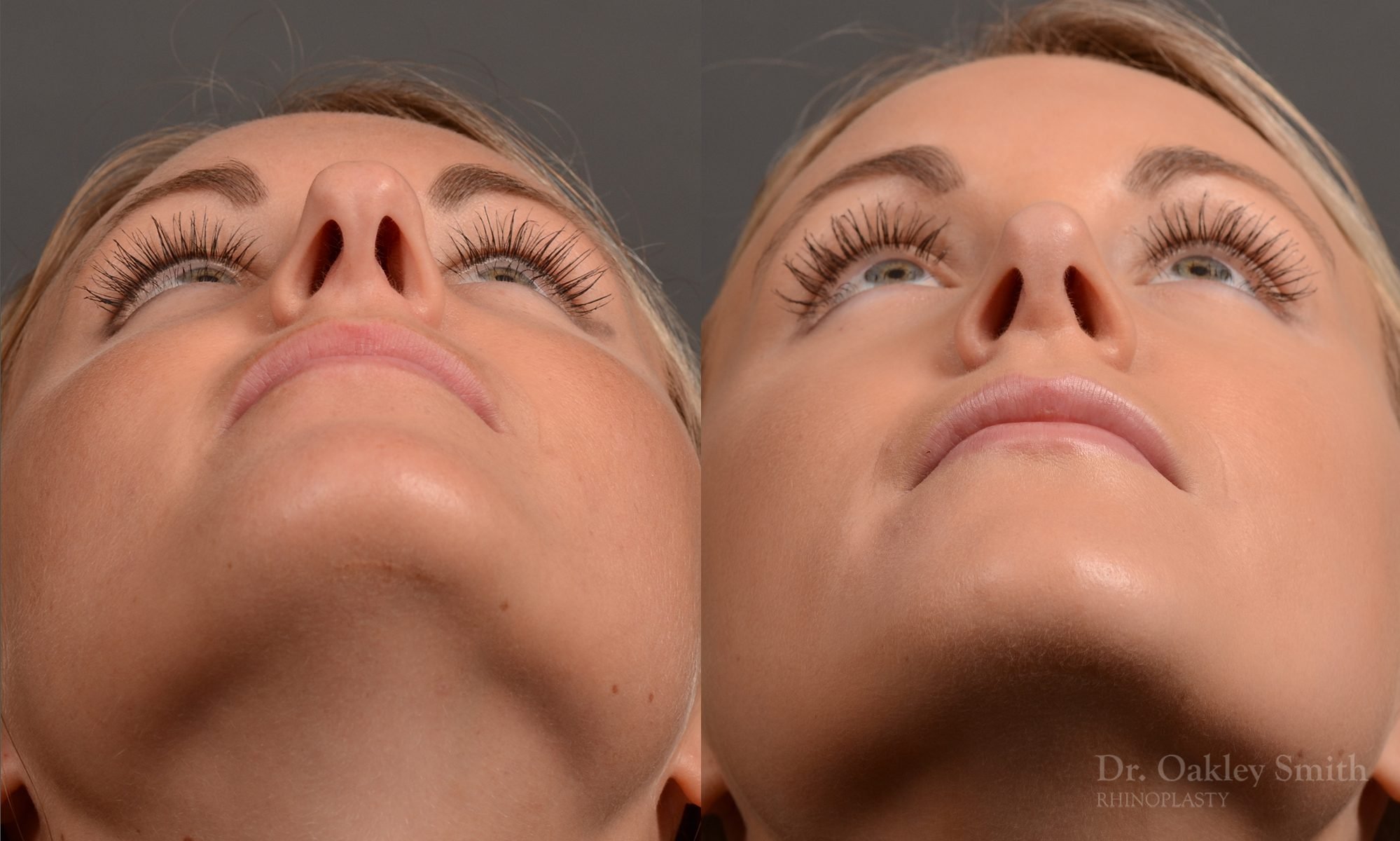 rhinoplasty Nothing demonstrates the skillful craftsmanship that Dr. Oakley Smith accomplishes during his surgeries than a collection of before and after case studies. As one of a hand full of surgeons in North America who limits his practice to only Rhinoplasty surgery, it is obvious that he has mastered his art. There is no question why he is one of the busiest cosmetic nose job surgeons in the country.
